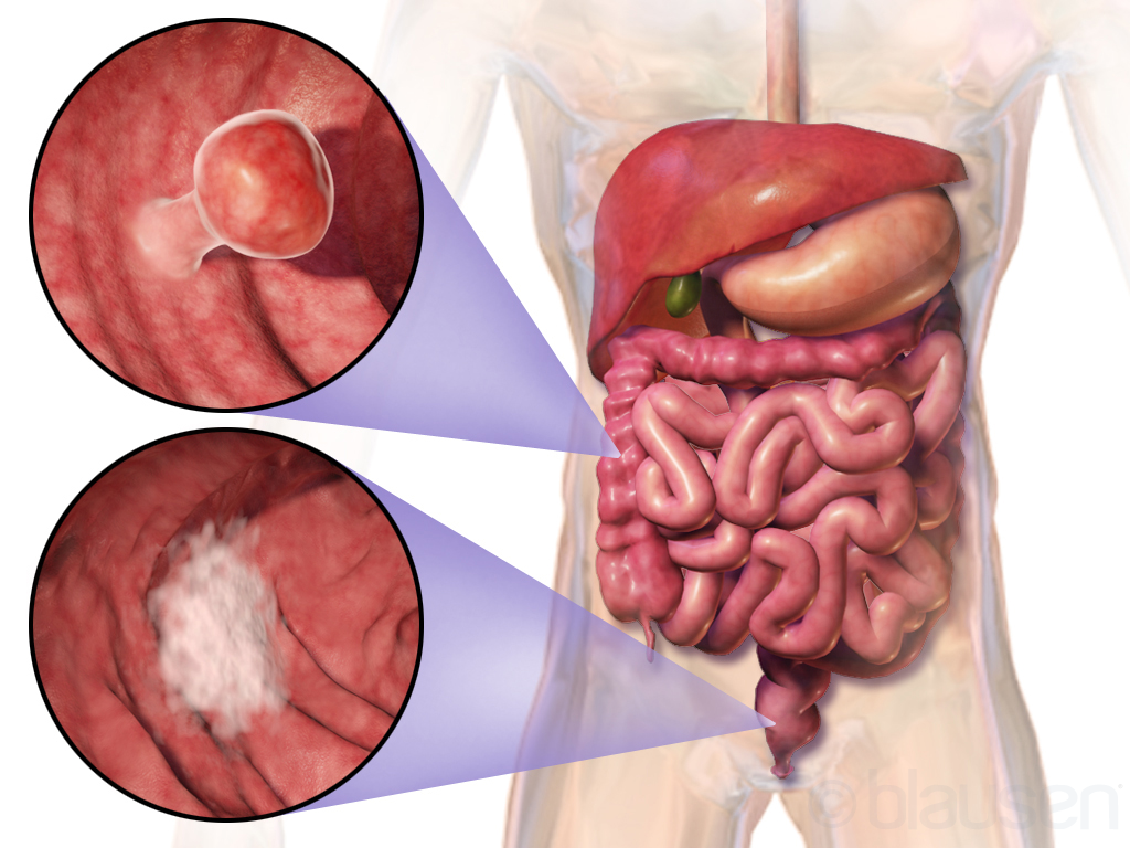 colon cancer symptoms