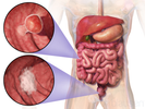colon cancer symptoms