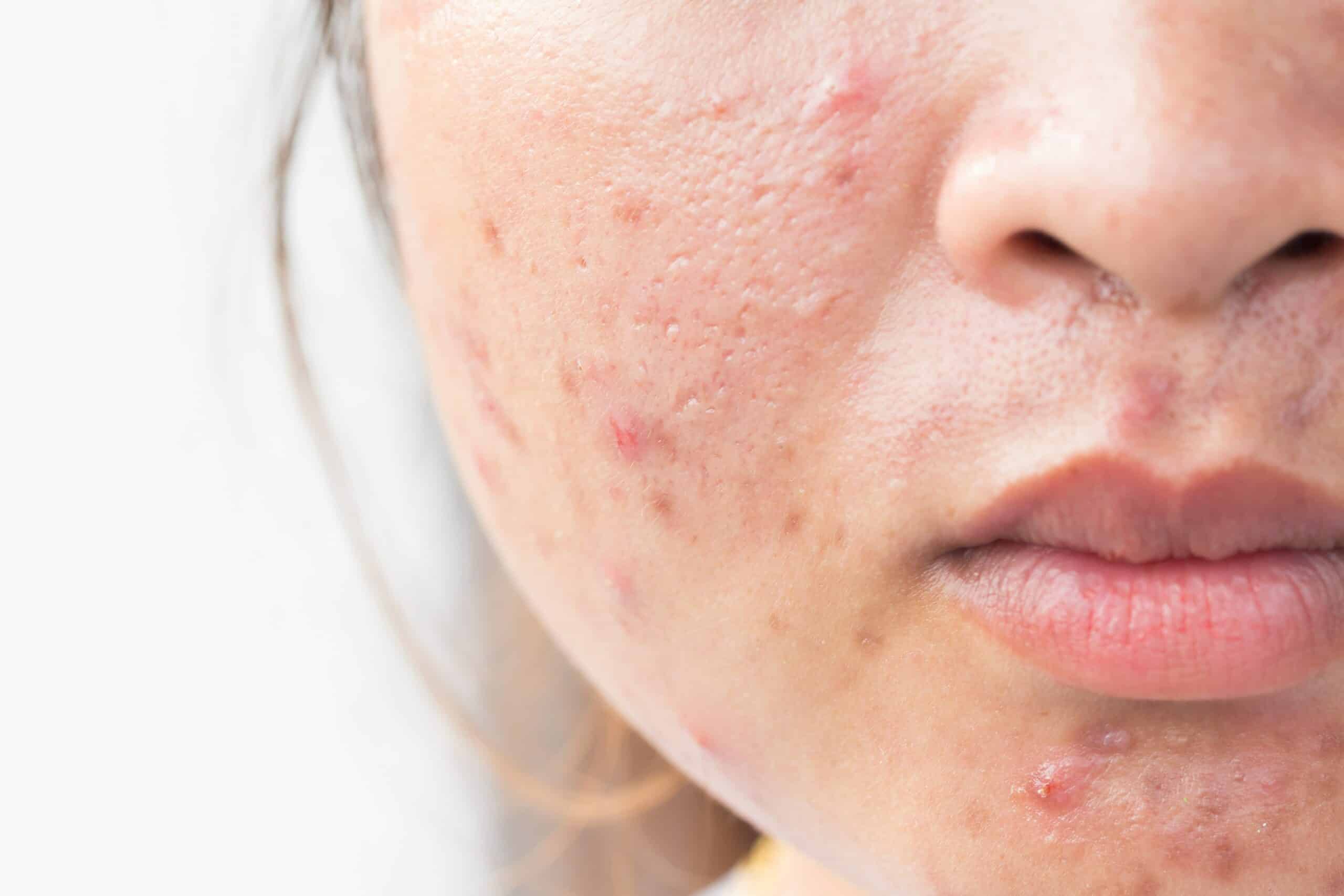 How to Reduce Acne Spots