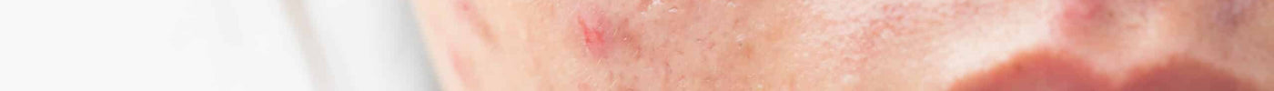 How to Reduce Acne Spots