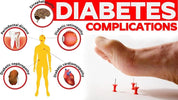 Complications of Diabetes